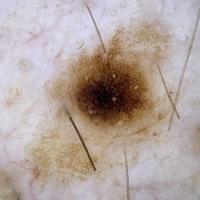 Dermoscopically a hypermelanotic naevusSome…