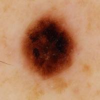 Dermoscopic appearance of previous figure showing…