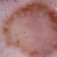
	Dermoscopic appearance of  previous…