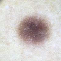 Dermoscopic appearance of previous figure -…