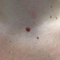 Dermal naevus