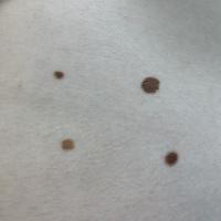 Acquired melanocytic naevi&nbsp;
Multiple naevi…