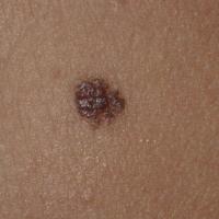 
	Dermal naevus