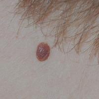 
	Dermal naevus