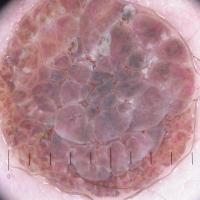
	Dermoscopic appearance of  previous…