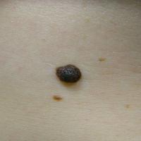 
	Dermal naevus&nbsp;