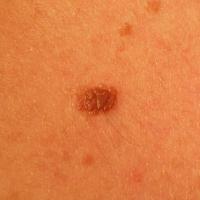 
	Dermal naevus

	Symmetrical, evenly coloured…