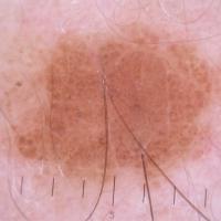 
	Dermoscopic appearance of  previous image