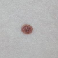 
	Dermal naevus