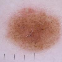 
	Dermoscopic appearance of  previous image