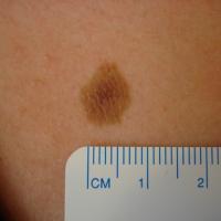 
	Dermal naevus
	
	Copied with kind permission…