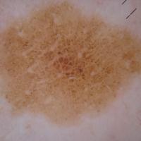 
	Dermoscopic appearance of  previous…