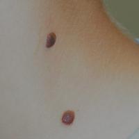 Dermal naevi