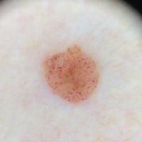 Dermoscopic appearance of previous figureComma…