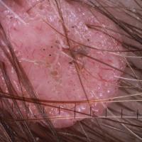 
	Dermoscopic appearance of  previous…