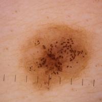 
	Dermoscopic appearance of a dermal naevus

	In…