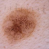
	Same patient as previous image - three months…
