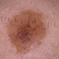 
	Same patient as previous image - nine months…