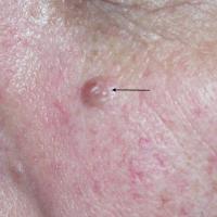 
	Dermal naevus