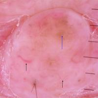 
	Dermoscopic appearance of  previous…