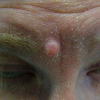 
	Dermal naevus

	Over time melanocytic naevi…