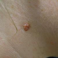 
	Dermal naevus