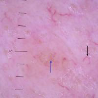 
	Dermoscopic appearance of&nbsp; previous…