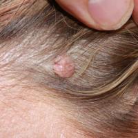 
	Dermal naevus in the scalp

	At this site…