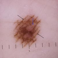 Dermoscopic appearance of previous imageLesions…