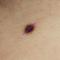 
	Acquired melanocytic naevus

	A regular shape.…