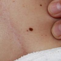
	Acquired melanocytic naevus