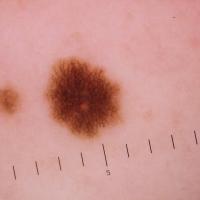 
	Dermoscopic appearance of previous image

	A…