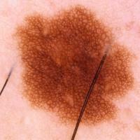 Dermoscopic appearance of previous imageA typical…