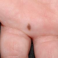 
	Acquired melanocytic naevus of the palm