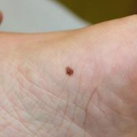 Acquired melanocytic naevus of the sole of the…