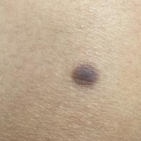 Benign melanocytic naevus - skin of colour