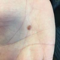 Benign melanocytic naevus - palpable&nbsp;Copied…