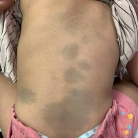 Congenital dermal melanocytosis -…