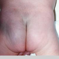 
	Congenital dermal melanocytosis