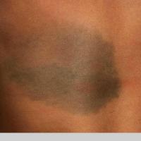 
	Congenital dermal melanocytosis

	&nbsp;