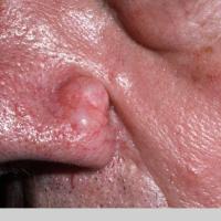
	Cutaneous focal mucinosis