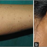 
	Localised LM&nbsp;

	Lesions demonstrating…