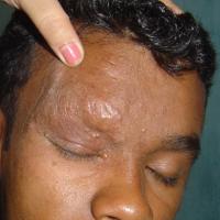 
	Alopecia mucinosa&nbsp;