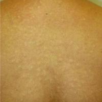 
	Papular mucinosis secondary to systemic lupus…