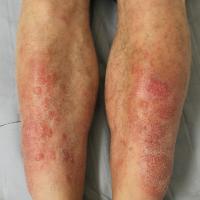 
	Pre-tibial myxoedema 