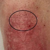 
	As previous image

	Hairs retracted in…