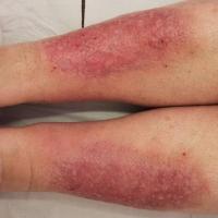 
	Pre-tibial myxoedema

	Copied with kind…