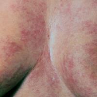 
	Reticular erythematous mucinosis