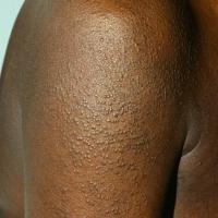 
	Scleromyxoedema

	Original source -…