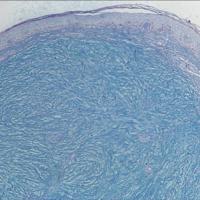 
	Mucin enhanced by Alcian blue stain